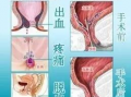 女性混合痔疮手术视频,女性混合痔疮手术过程解析与康复指导